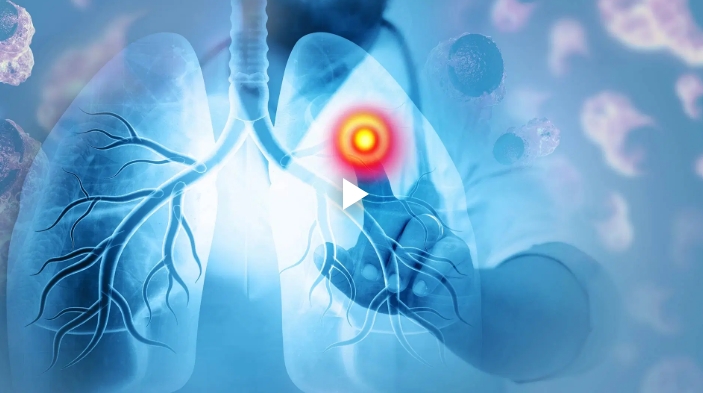 Xpeer HRCT for ILD: Summer Webinar Series with Prof. Prokop