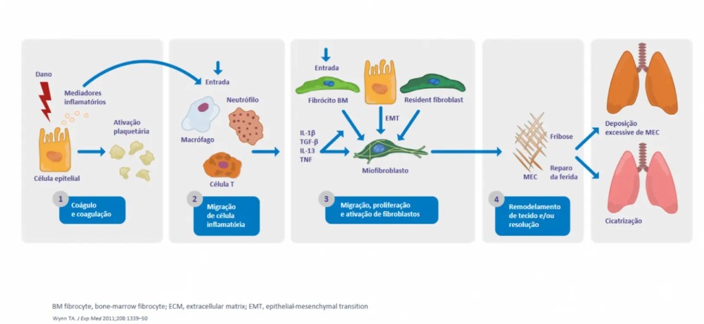 Surgimento de fibrose pulmonar progressiva
