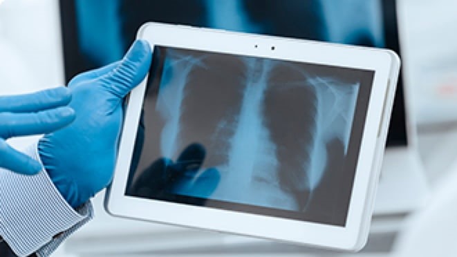 A progressão radiográfica precoce da DPI-ES prediz mortalidade a longo prazo