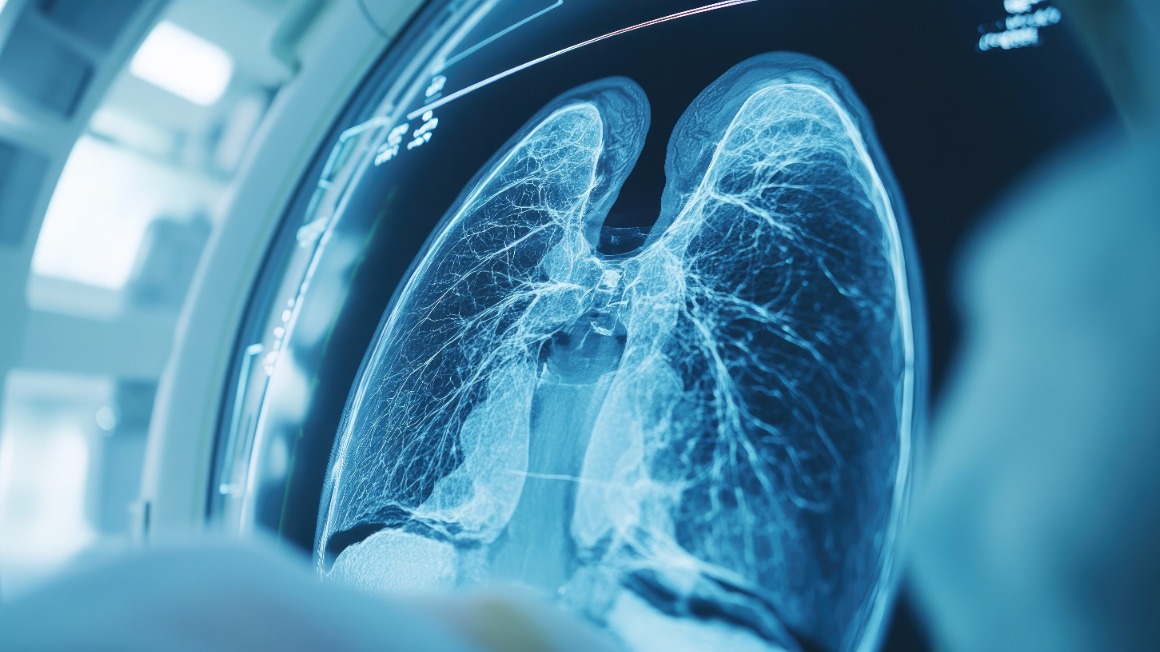 Nintedanibe e progressão da fibrose pulmonar: o papel da TCAR quantitativa no estudo INBUILD®