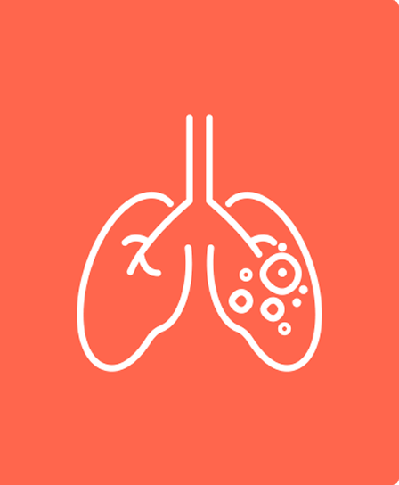 Suspeite de Fibrose Pulmonar