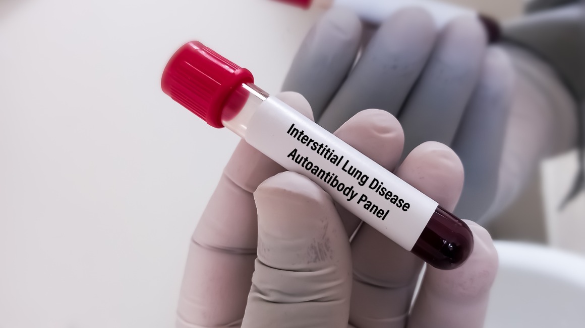 Highlights EULAR 2025 | Eficácia e segurança do nerandomilaste em pacientes com fibrose pulmonar progressiva relacionada a doenças autoimunes: análise de subgrupos do ensaio FIBRONEER-ILD