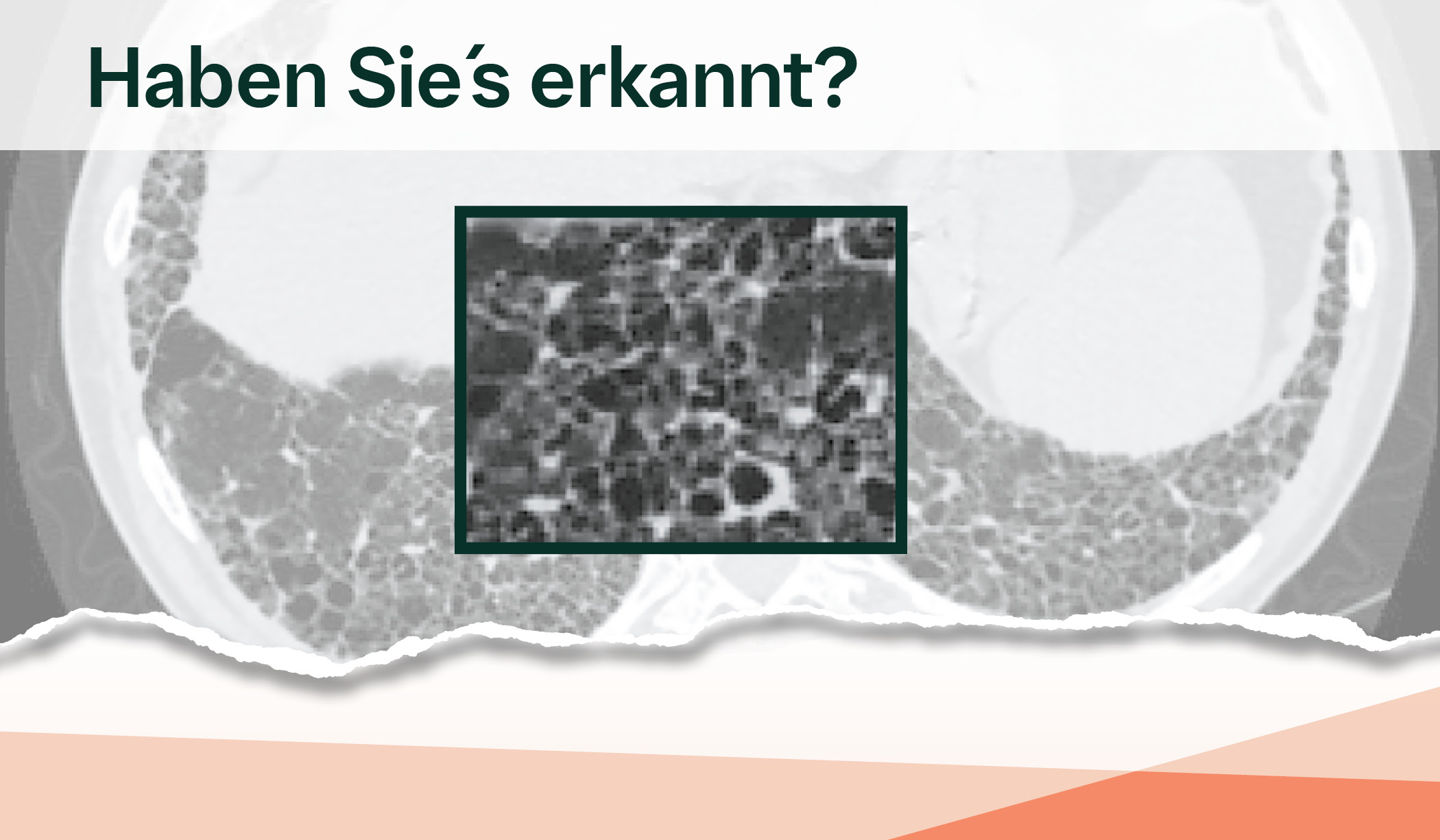 Honigwaben im HRCT-Bild der Lunge