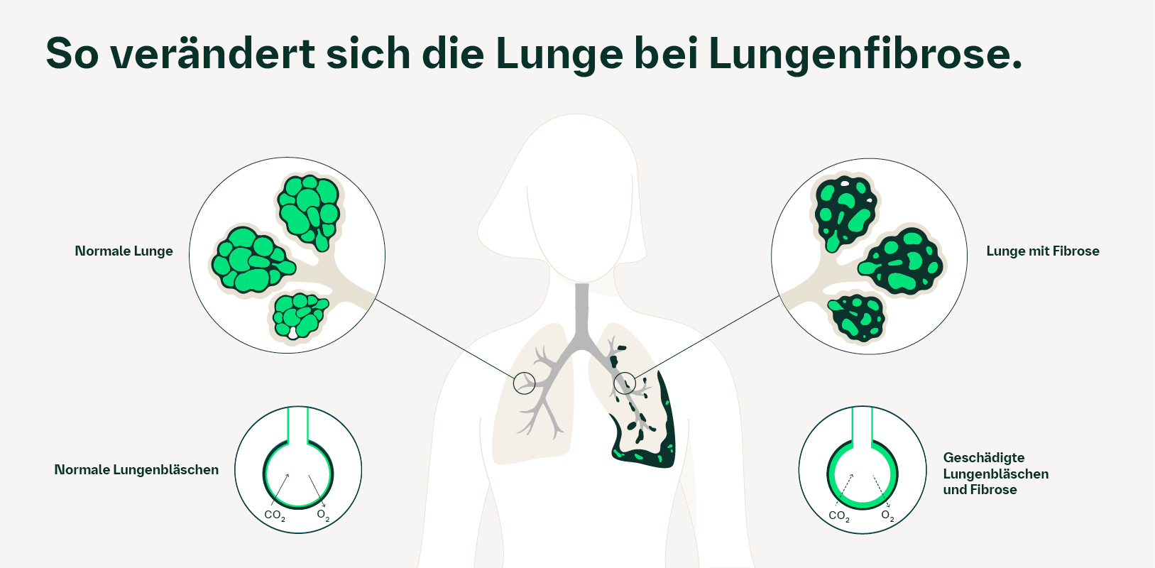So verändert sich die Lunge bei Lungenfibrose