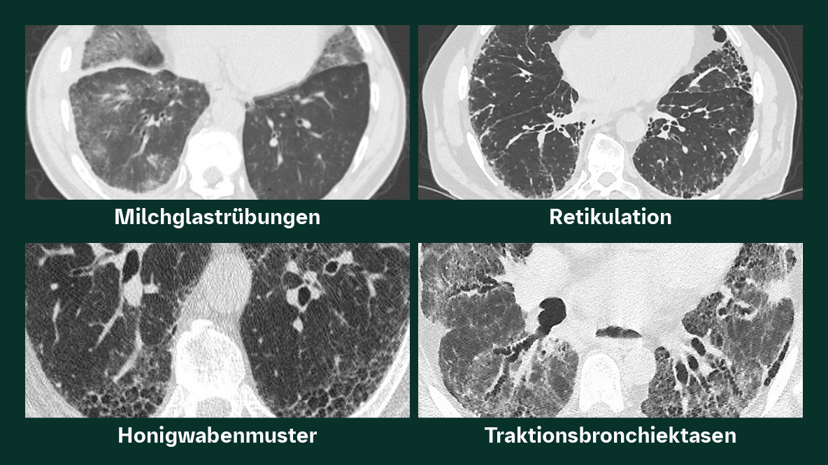 Fibrose-Zeichen von Milchglastrübung, Retikulation, Honigwabenmuster und Traktionsbronchiektasen im HRCT