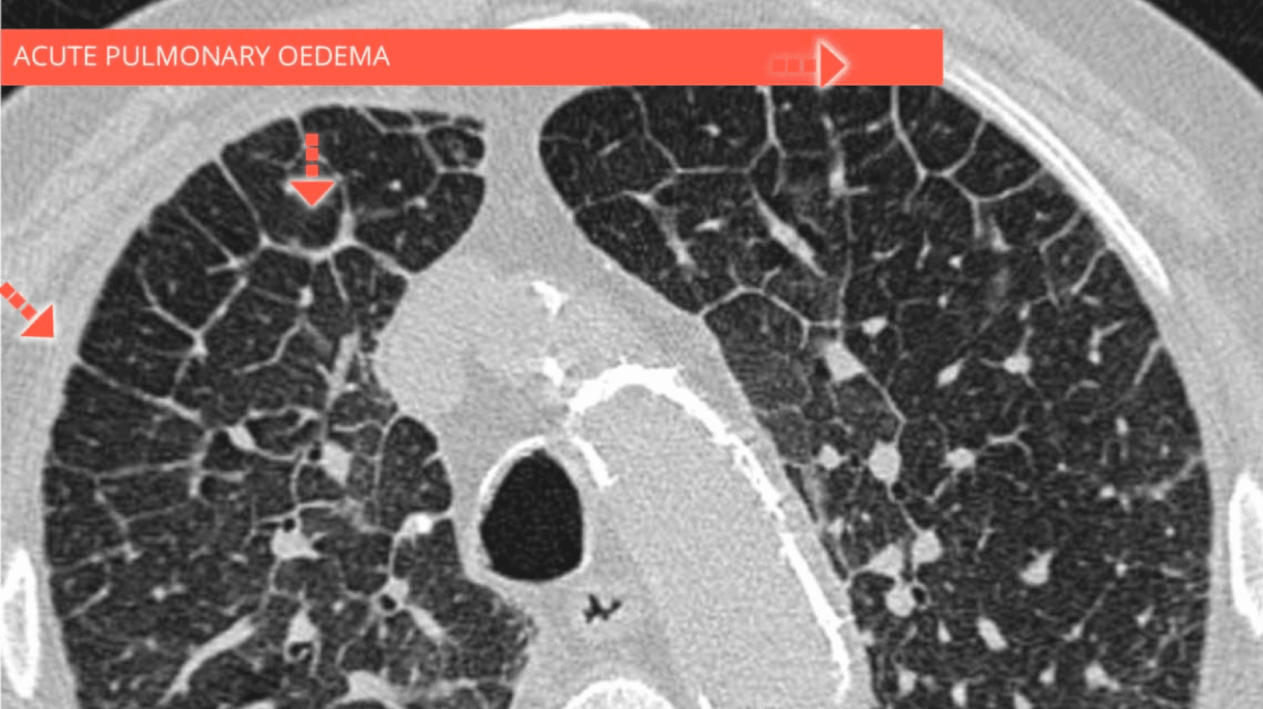 Interlobular septal thickening | Imaging Atlas