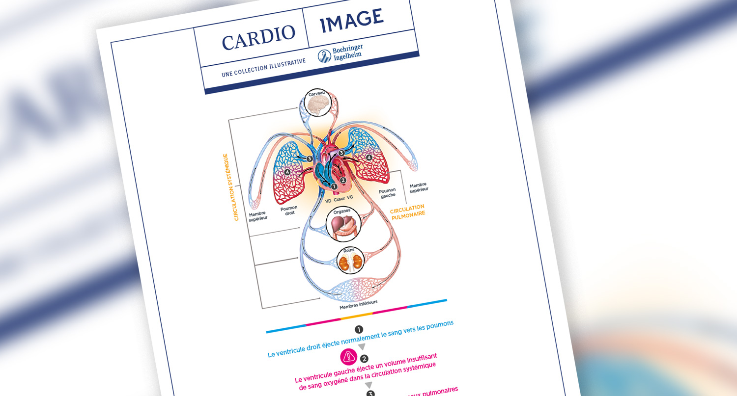 Planche n°2 : Insuffisance cardiaque gauche : congestion pulmonaire