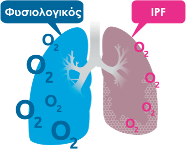 Ιδιοπαθής Πνευμονική Ίνωση (IPF): Δείτε περισσότερα