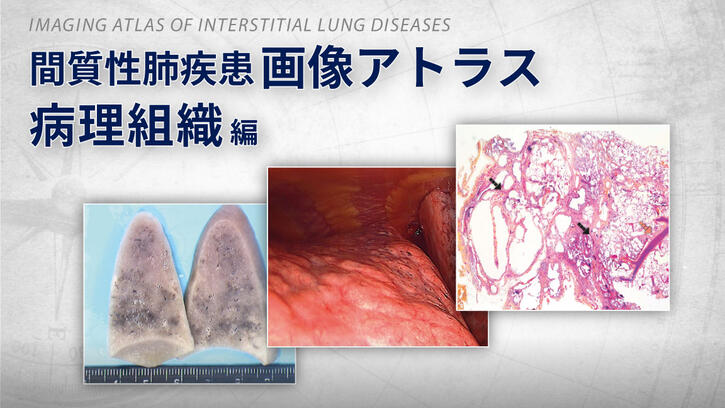 オフェブ関連コンテンツ 間質性肺疾患画像アトラス 病理組織編｜べー 