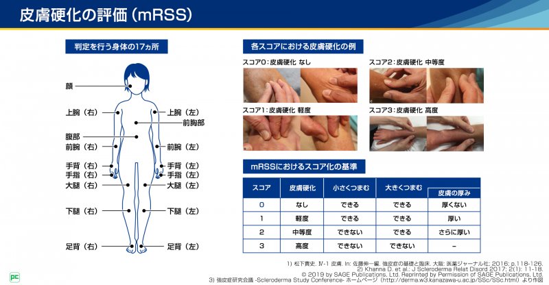 難病医療費助成制度の申請方法　～SSc～02