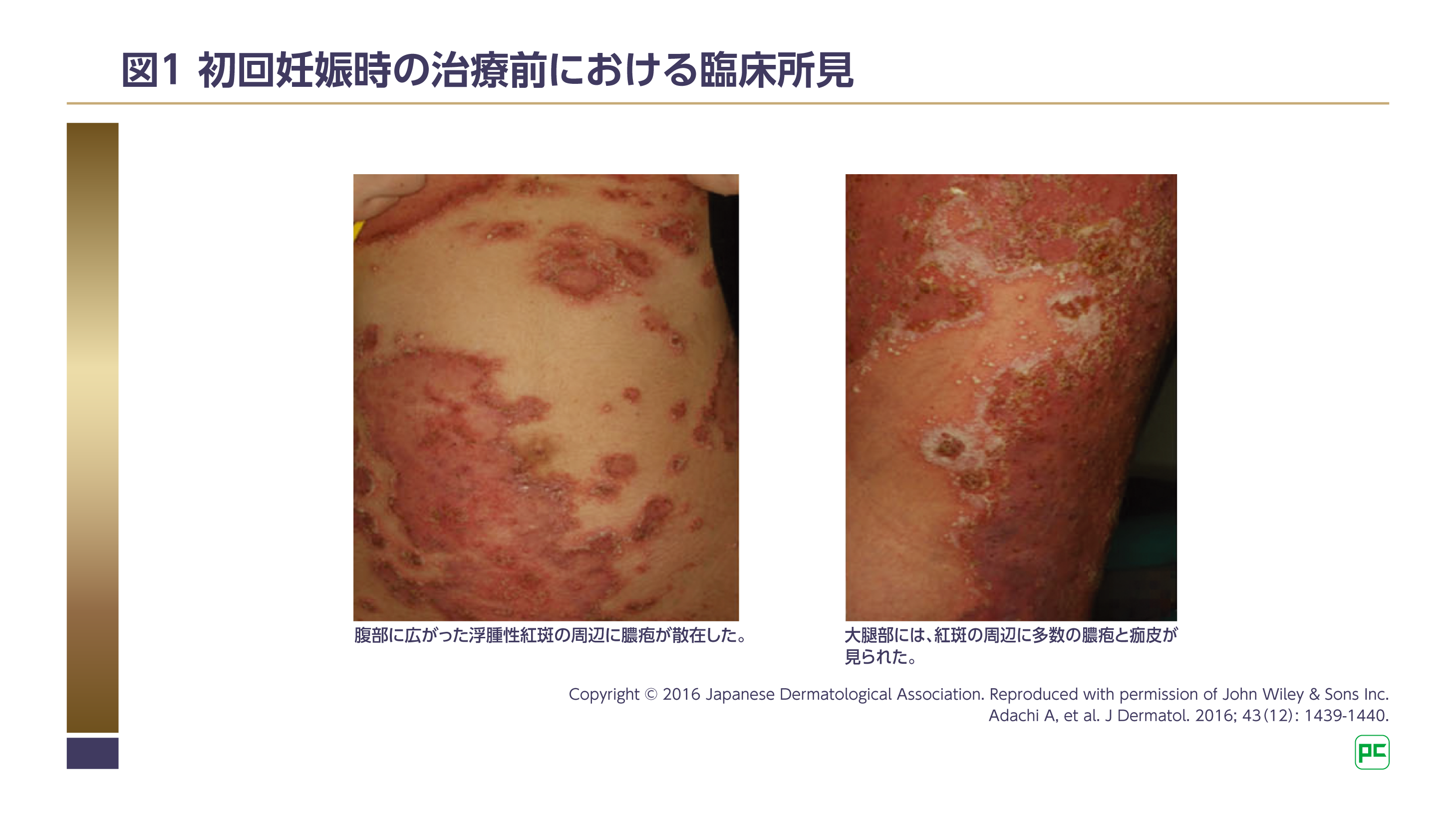 ☯一切悪瘡治之御秘符　[bL5l6d12]　皮膚疾患　毒瘡　腫物悪瘡　等に Amazon | 【第2類医薬品】オノフェF 7g | 森下仁丹 | 皮膚