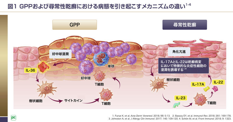 尋常性乾癬とGPPの異なる病態について02