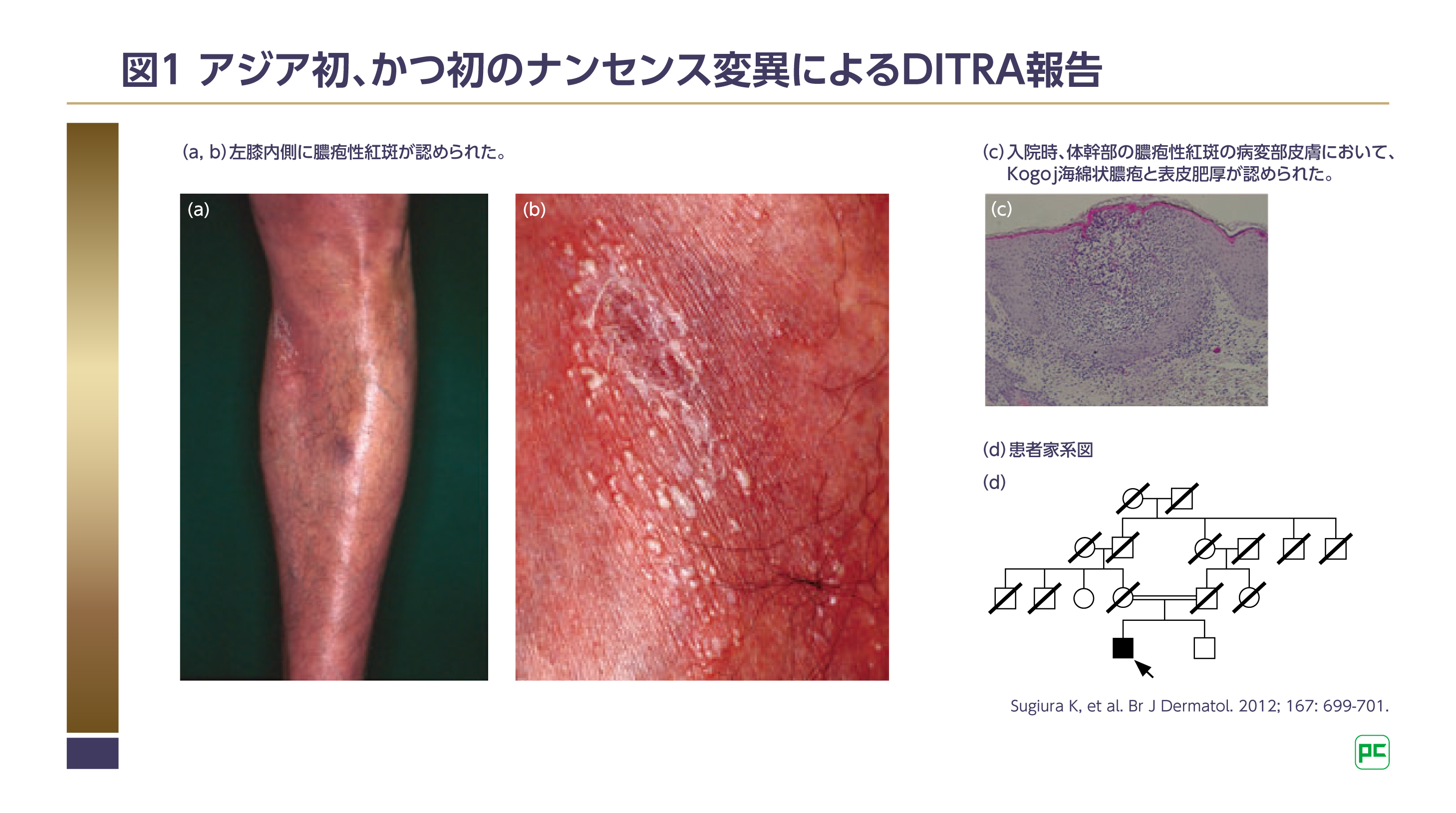 こう治す　複合汚染アレルギー II型アレルギー（細胞障害型）【画像＋プチ解説】 | 徹底的解剖