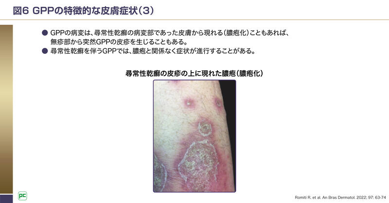 膿疱性乾癬の見通し