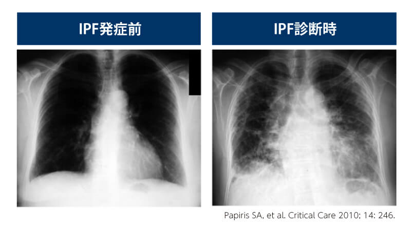 図3 IPF発症前および診断時の胸部X線画像