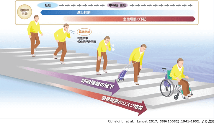 図1 IPFの臨床経過(概念図)
