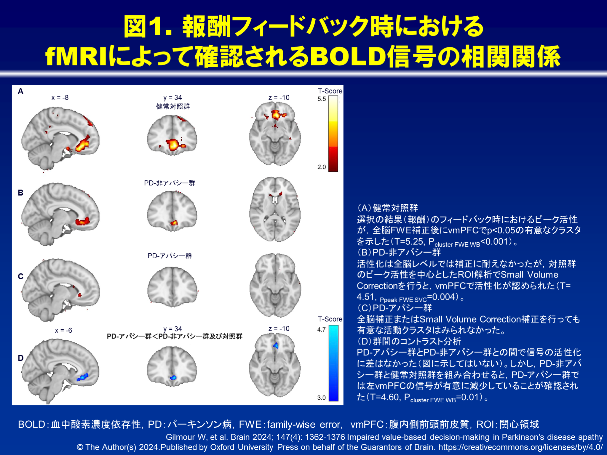 パーキンソン病のアパシーにおける価値に基づく意思決定の障害｜べーリンガープラス