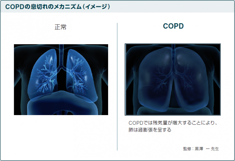 COPD患者さんの息切れ症状改善には残気量の減少が必要です。スピオルト®レスピマット®は、残気量減少に優れた薬剤です。