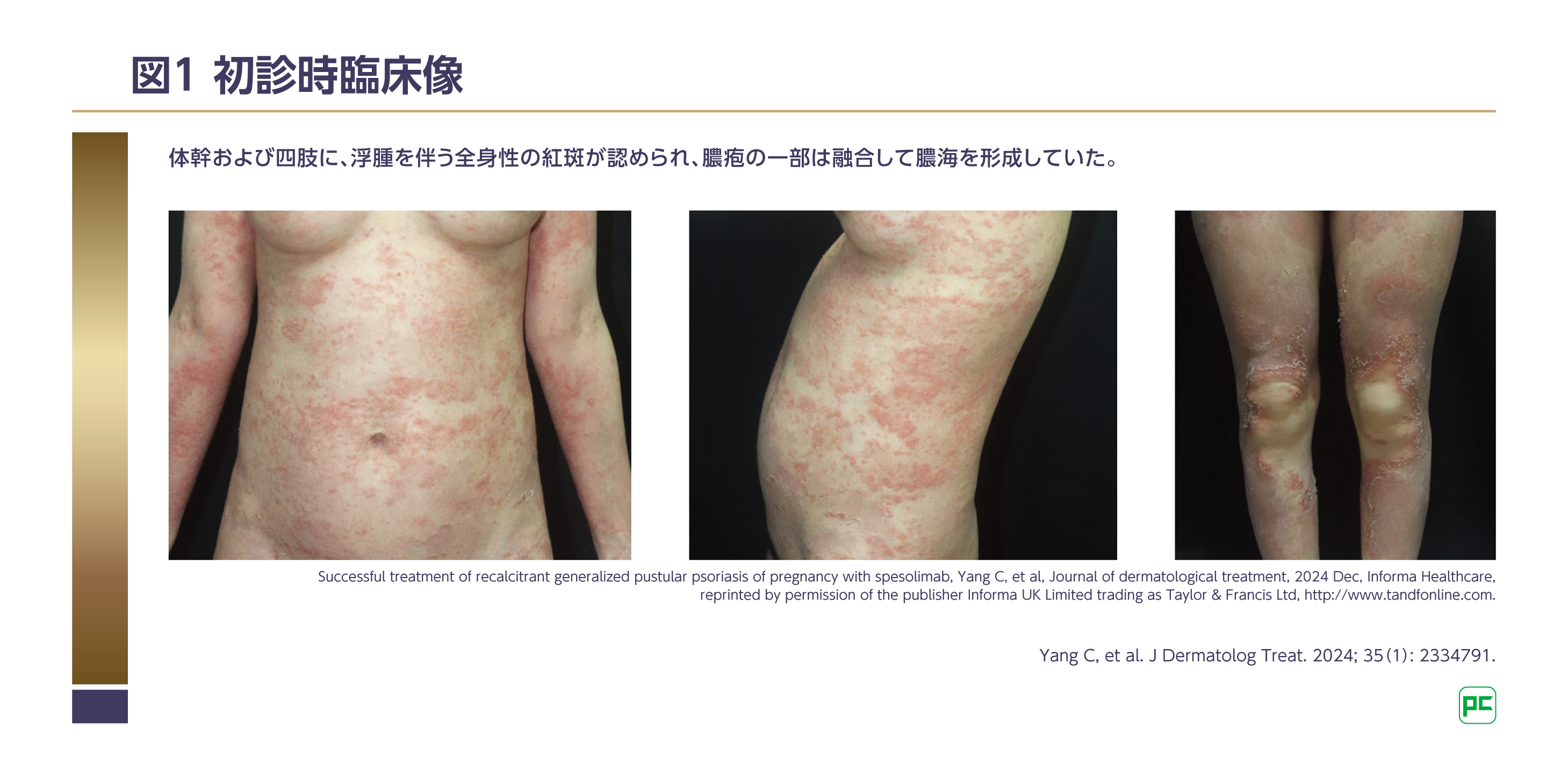 この皮疹、何を疑う？ 第2回：体幹および四肢に紅斑・膿疱を認め