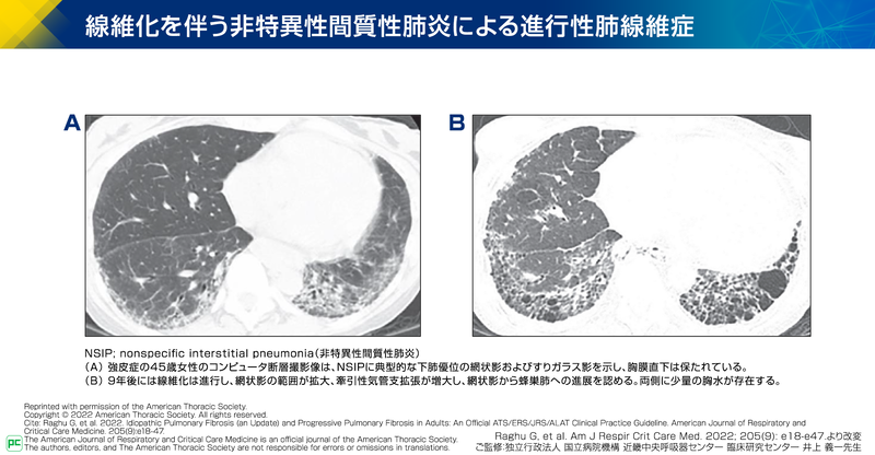 進行性肺線維症（PPF）の定義03