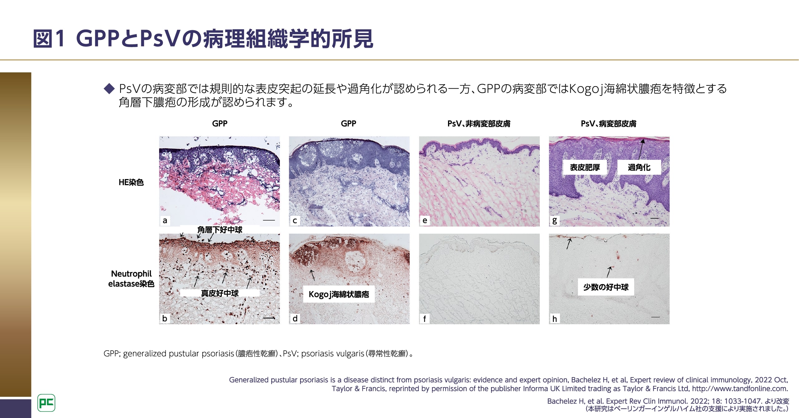 GPPの病変部皮膚におけるIL-36シグナル伝達経路の重要性 | べー GPPの病変部皮膚におけるIL-36シグナル伝達経路の重要性 | べー