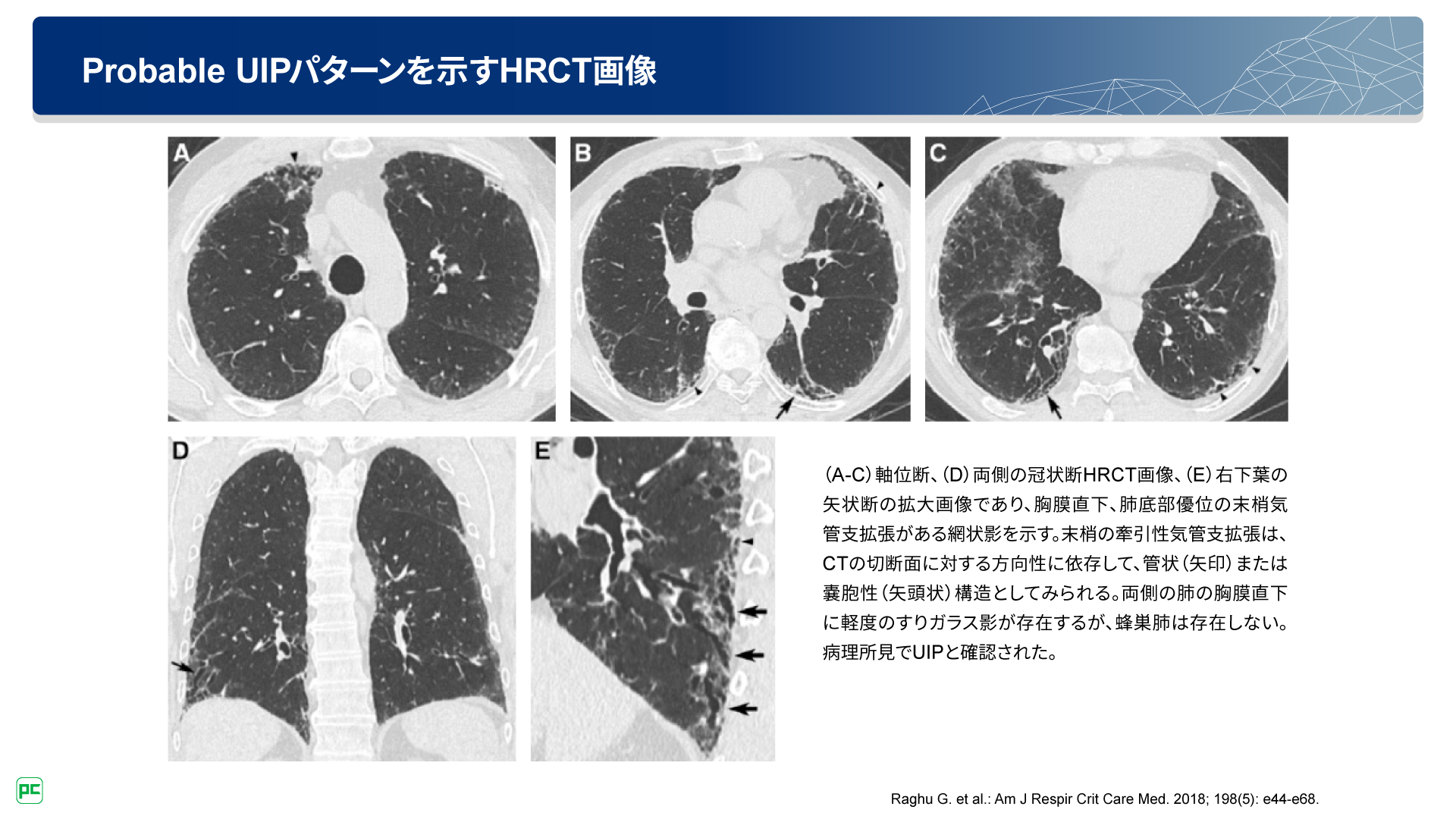 蜂巣肺のないIPF患者への治療介入の重要性（静止画）| べー