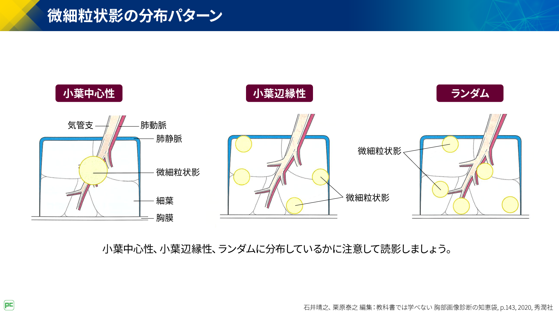 呼吸器疾患診療における胸部HRCT画像読影のポイント（静止画）｜べーリンガープラス