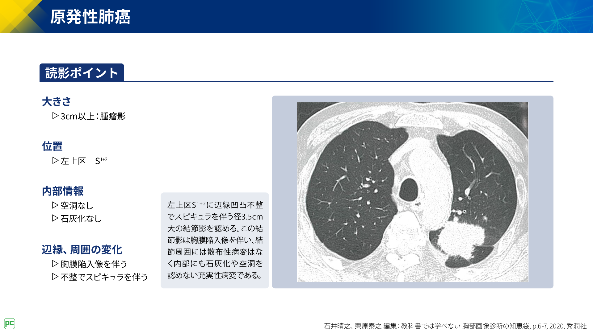 呼吸器疾患診療における胸部HRCT画像読影のポイント（静止画）｜べーリンガープラス