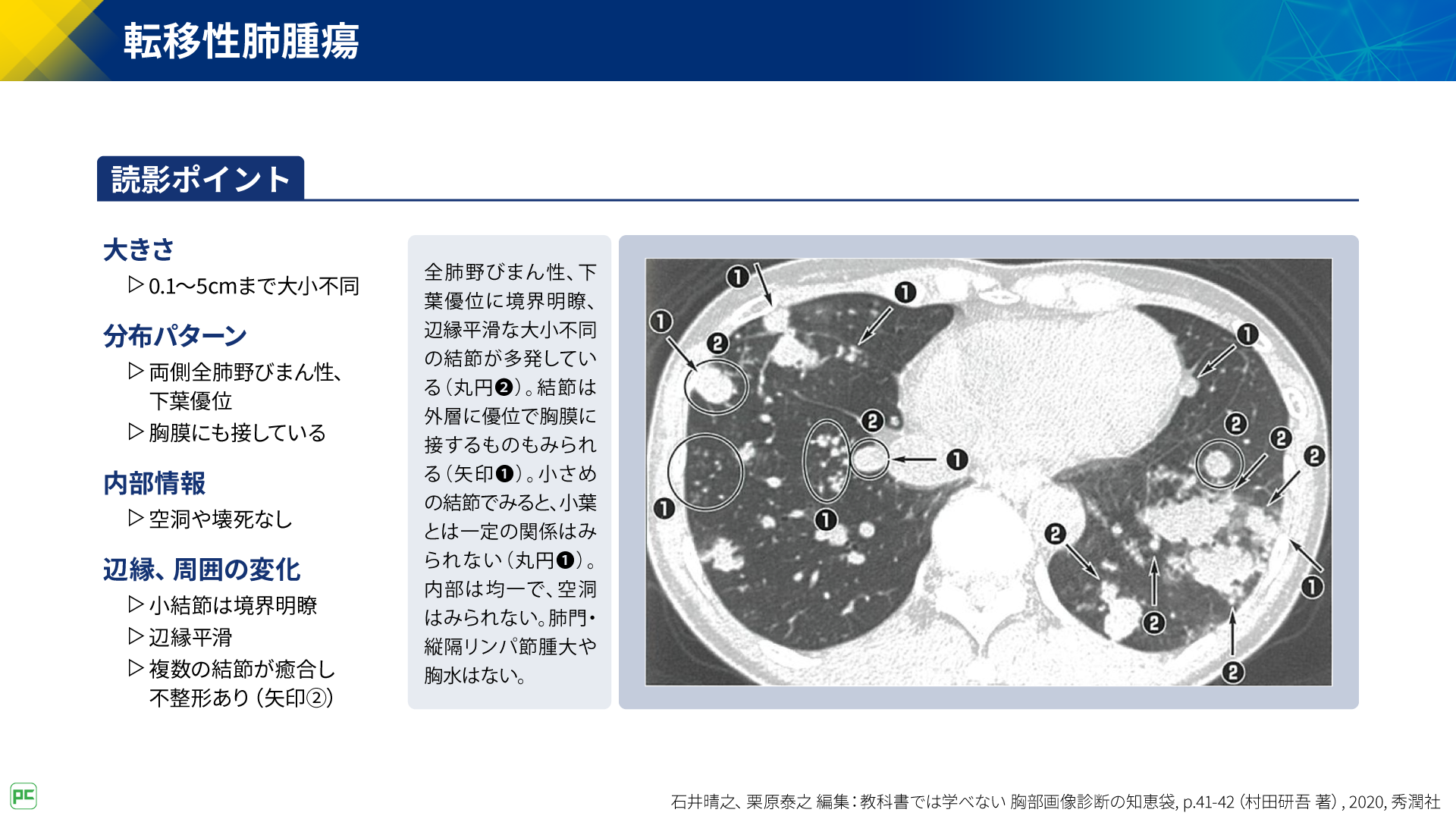 呼吸器疾患診療における胸部HRCT画像読影のポイント（静止画）｜べー 