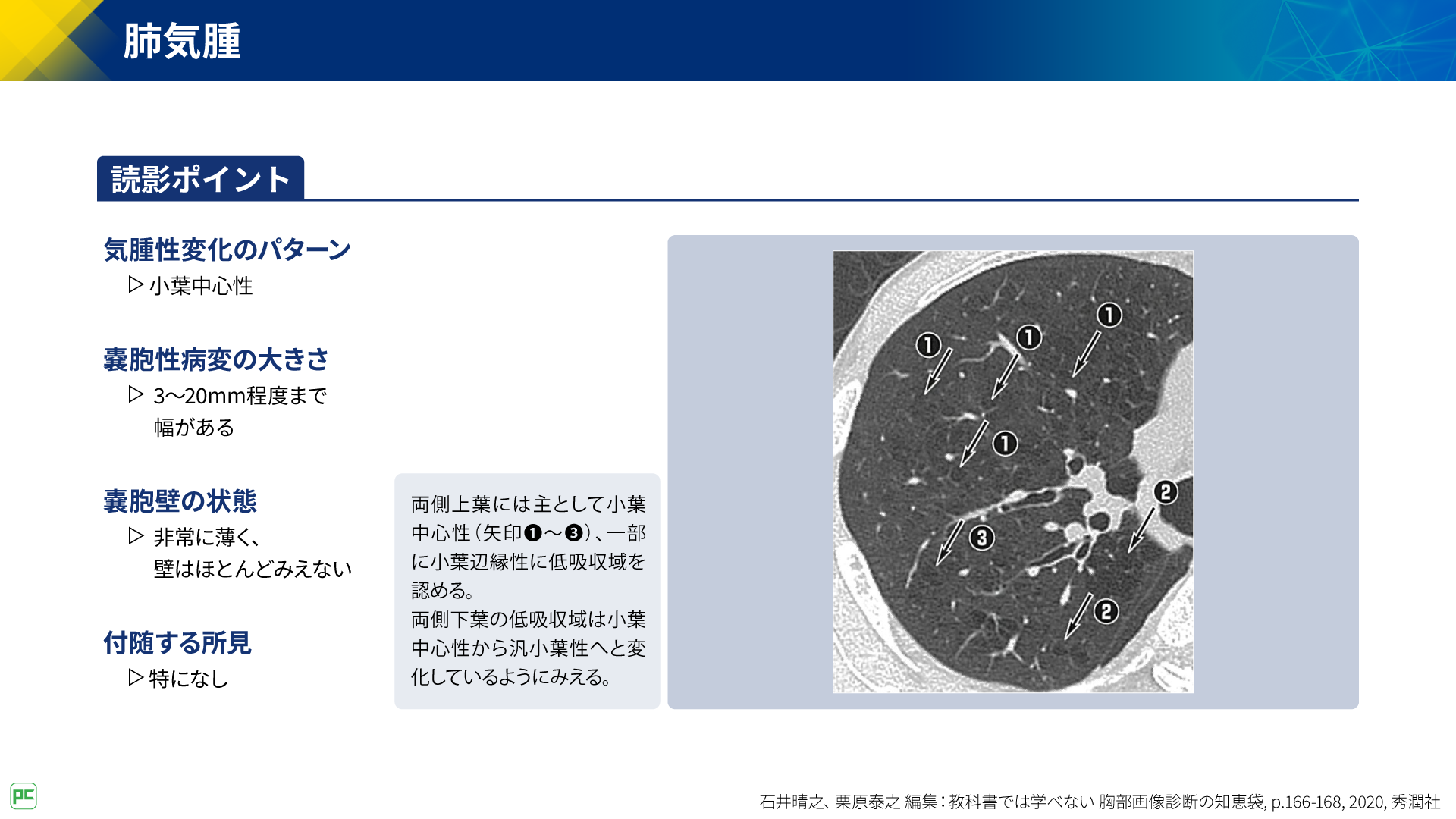 呼吸器疾患診療における胸部HRCT画像読影のポイント（静止画）｜べー 