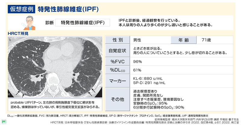 特発性肺線維症（IPF）の予後