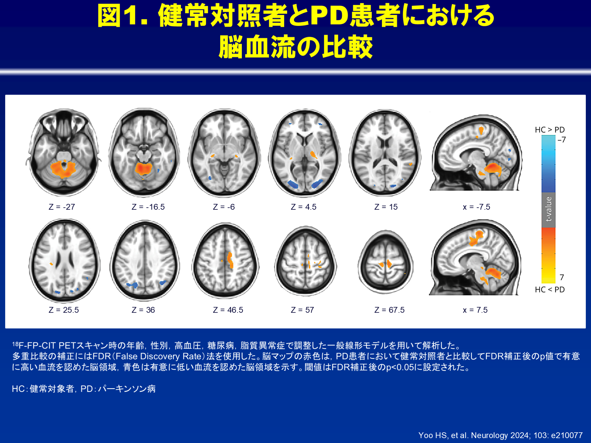 パーキンソン病における相対的な脳の過剰血流と運動機能障害との