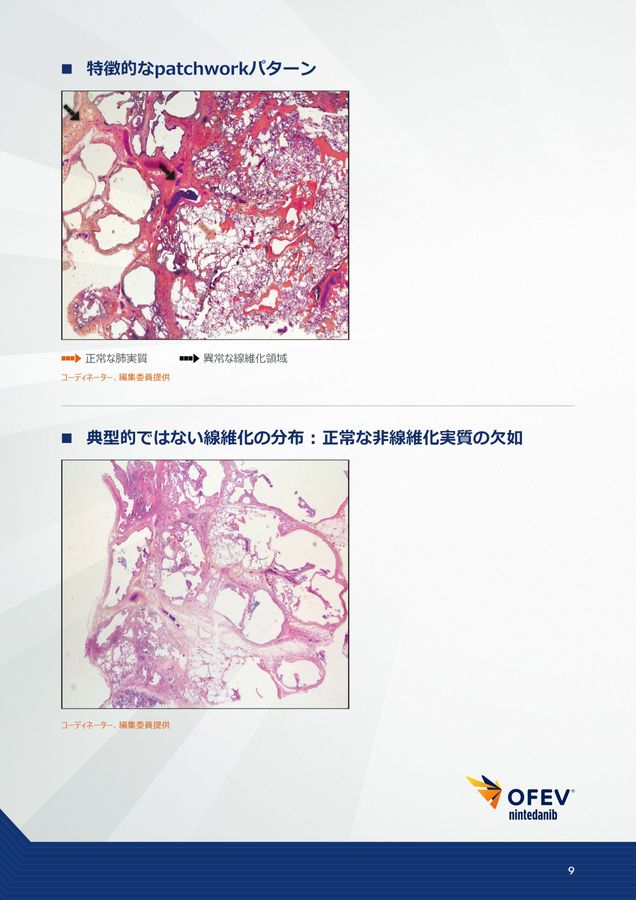 間質性肺疾患画像アトラス病理組織編