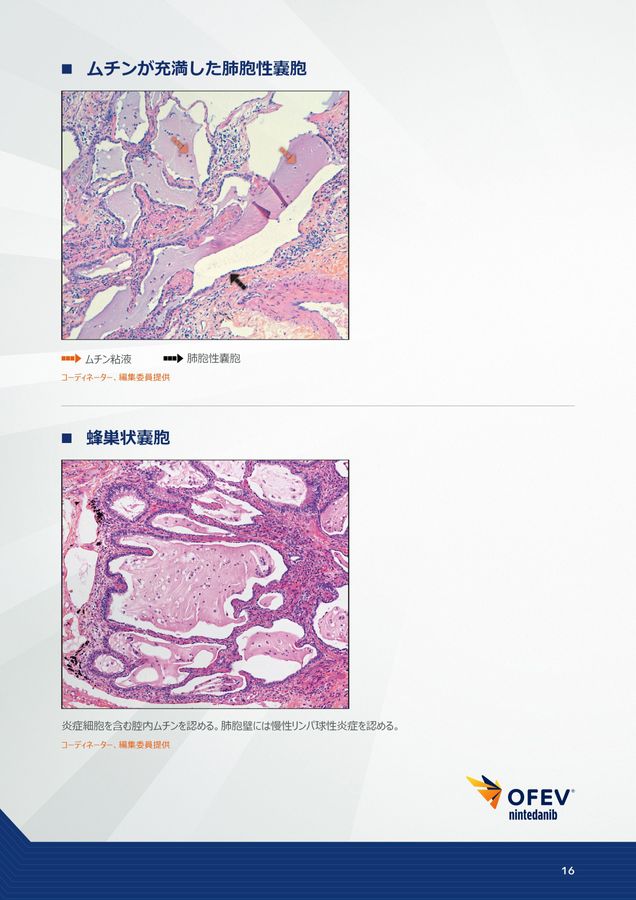 間質性肺疾患画像アトラス病理組織編