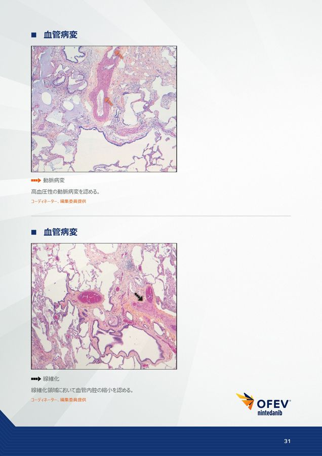 【裁断済み】非腫瘍性疾患病理アトラス肺 肺 (非腫瘍性疾患病理アトラス) | 蛇澤 晶, 熊坂利夫 |本 | 通販
