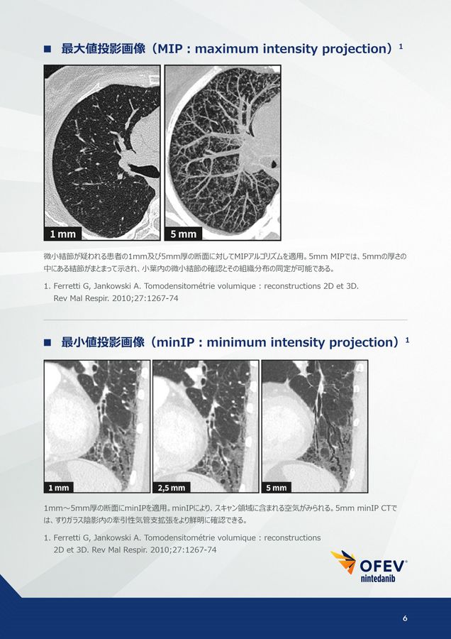 間質性肺疾患画像アトラス胸部HRCT編