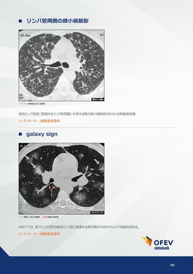 間質性肺疾患画像アトラス胸部HRCT編