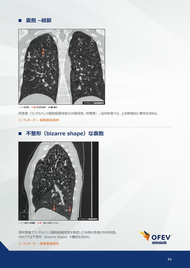 間質性肺疾患画像アトラス胸部HRCT編