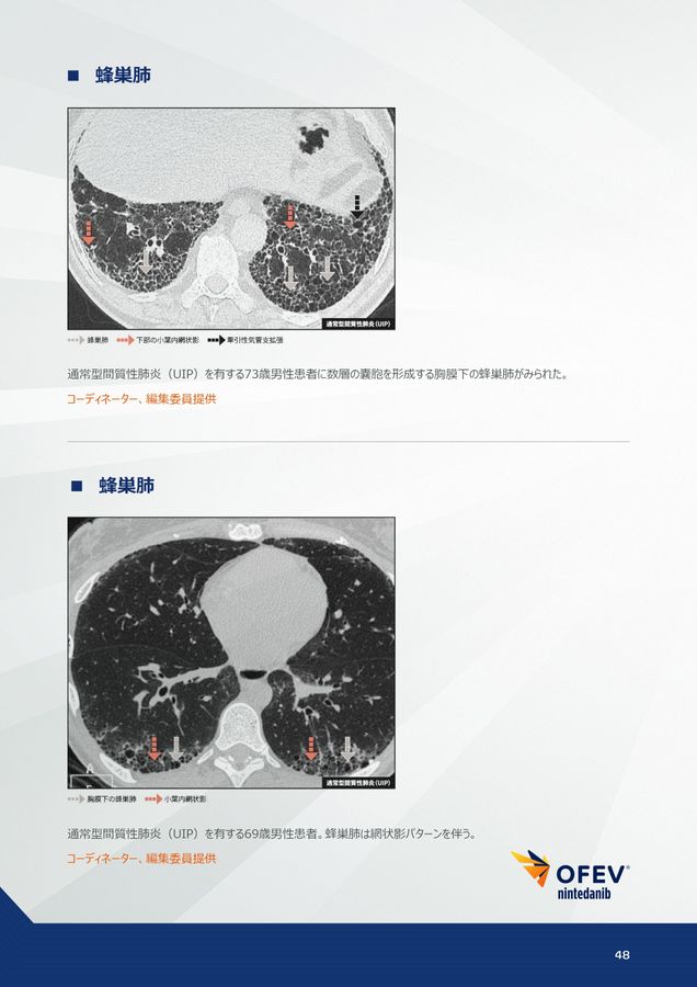 間質性肺疾患画像アトラス胸部HRCT編