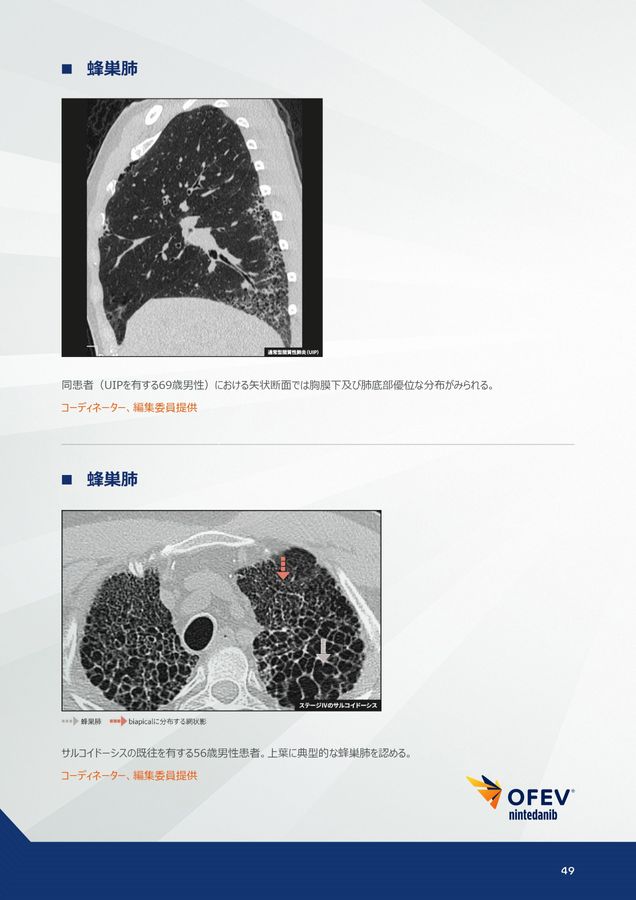 間質性肺疾患画像アトラス胸部HRCT編