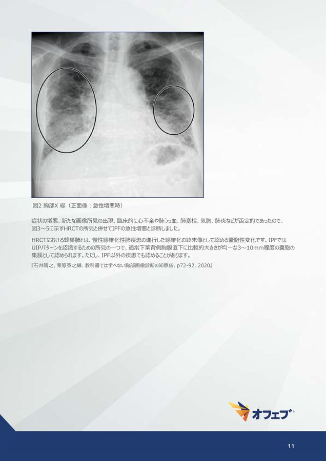 オフェブ関連コンテンツ 間質性肺疾患画像アトラス 画像読影の