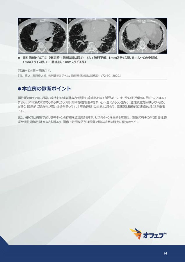 オフェブ関連コンテンツ 間質性肺疾患画像アトラス 画像読影の