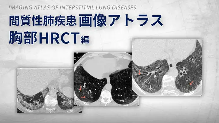 オフェブ関連コンテンツ 間質性肺疾患画像アトラス　胸部HRCT編