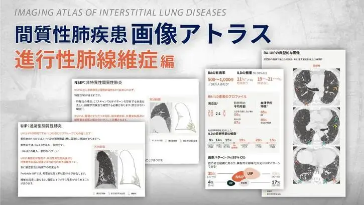 急性疾患をホメオパシーで治す : 急性疾患のスピリットから洞察される適合レメデ… 進行性線維化を伴うCTD-ILD診療における急性増悪予防の重要性