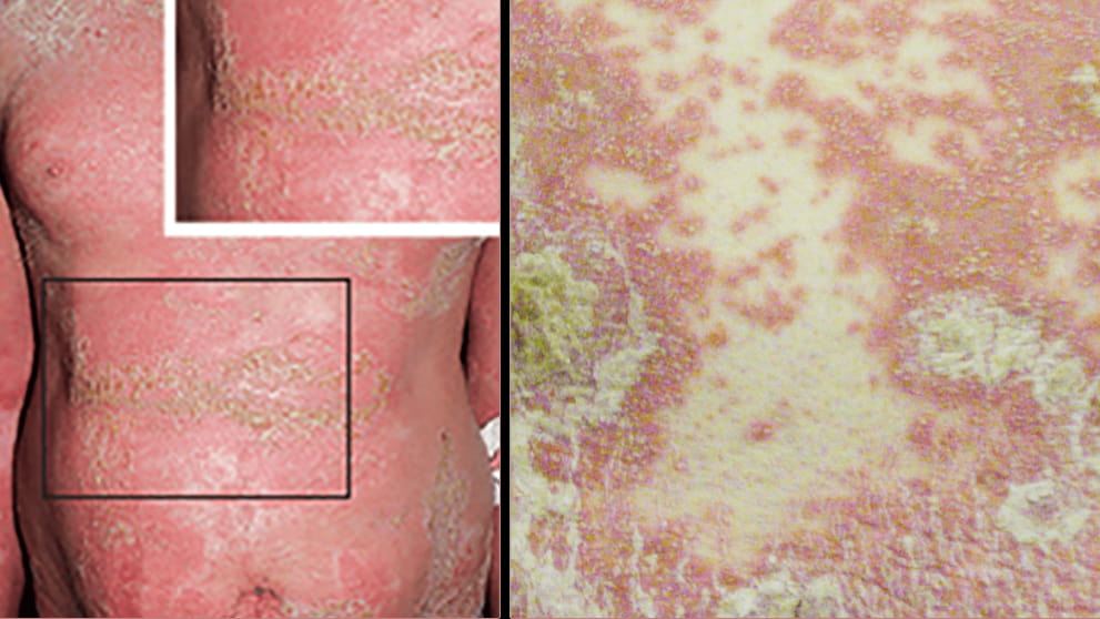 Understanding Generalized Pustular Psoriasis | GPP Walks In