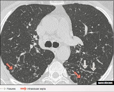 Perilymphatic Micronodulation