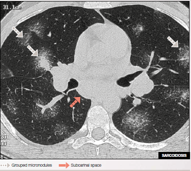 Perilymphatic Micronodulation