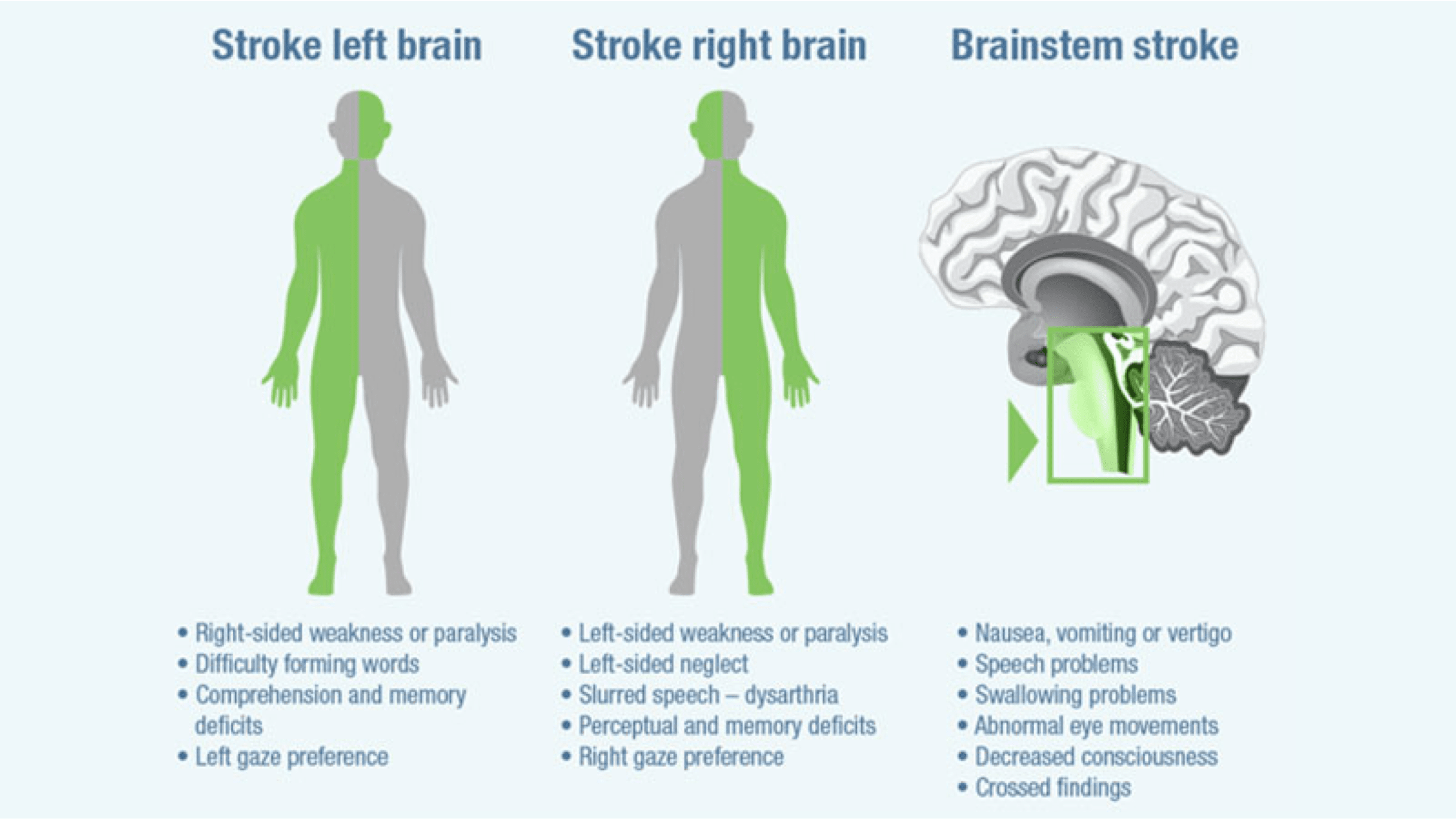 acute-ischaemic-stroke-symptoms-and-mimics-strokeforum