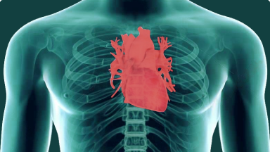 3D Heart - Chronic Heart Failure