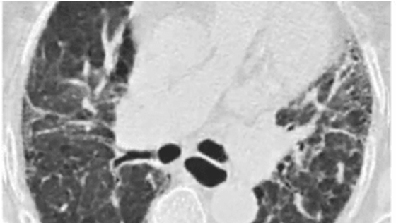 Fibrotic HP Case Study | ILD Radiology Rounds